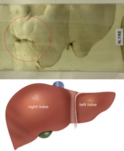 The sulcus, circled, is an anomaly