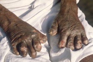 Leprosy2
