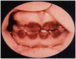 Heam-staining of the, enamel: "Erythrodontia" 